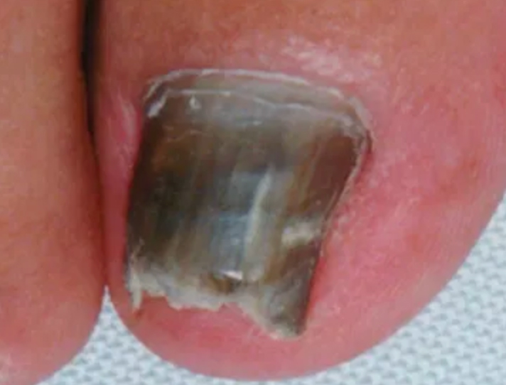 Chronic Paronychia: A Rundown Of The Fingernail Infection - Angeline Yong  Dermatology